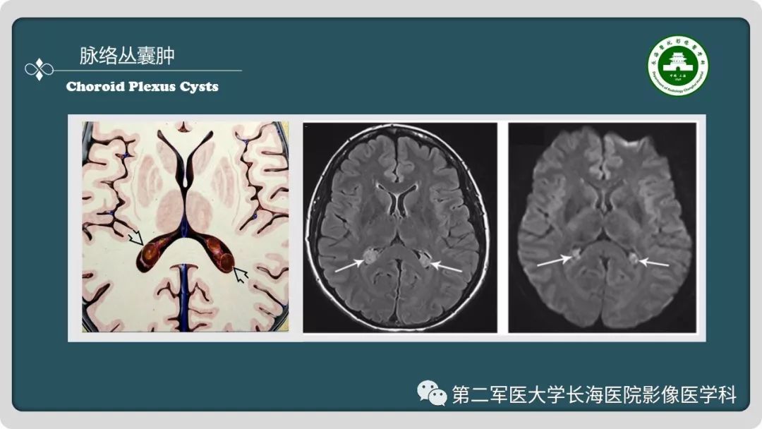 【PPT】颅内囊性病变影像表现-48