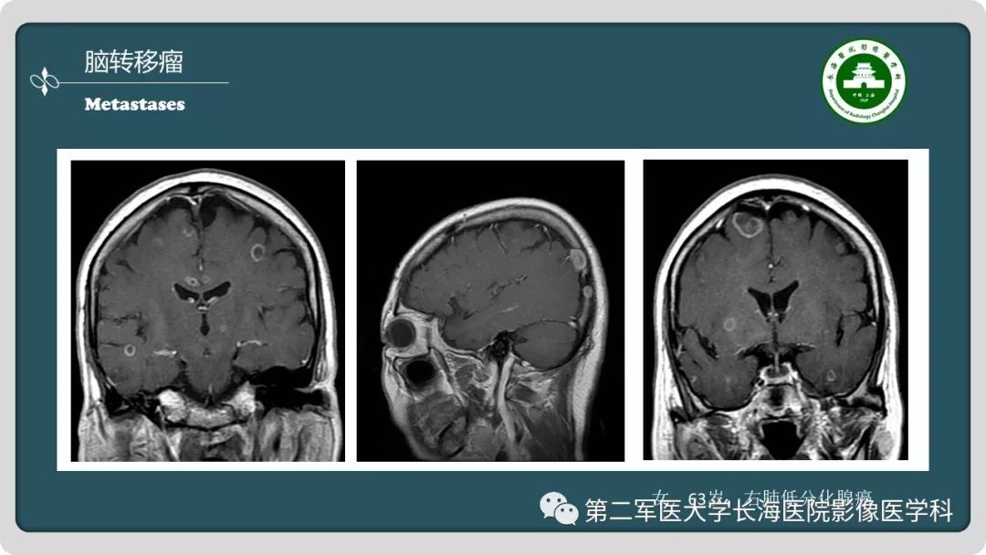 【PPT】颅内囊性病变影像表现-45