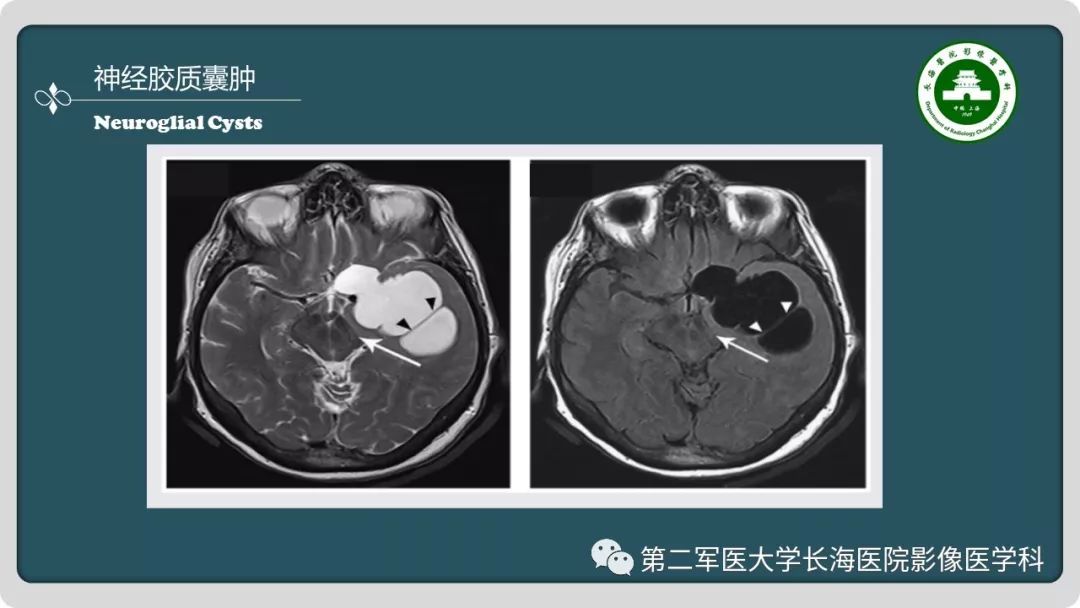 【PPT】颅内囊性病变影像表现-30