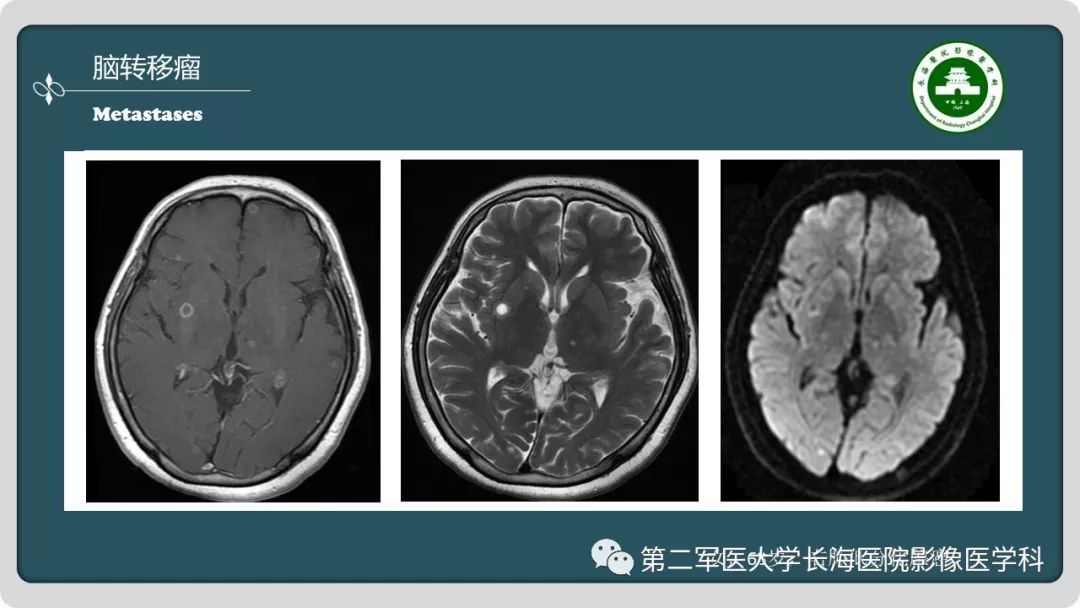 【PPT】颅内囊性病变影像表现-44