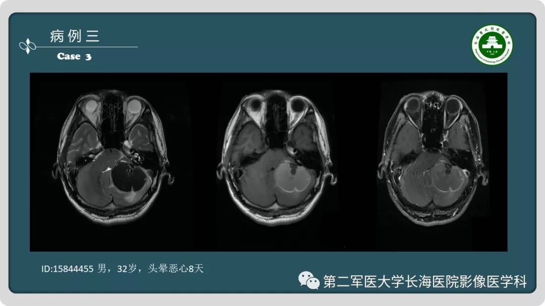 【PPT】颅内囊性病变影像表现-6