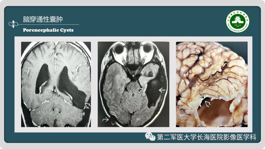 【PPT】颅内囊性病变影像表现-24
