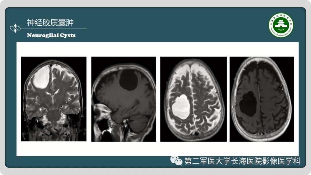 【PPT】颅内囊性病变影像表现-28