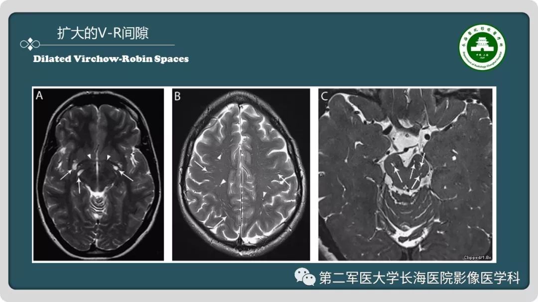 【PPT】颅内囊性病变影像表现-15