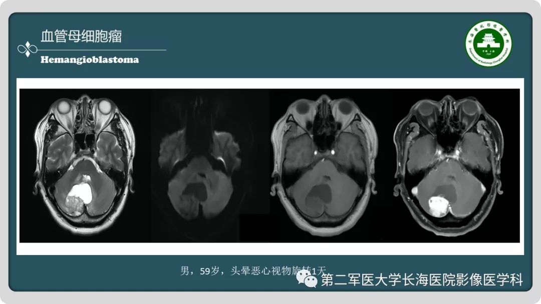 【PPT】颅内囊性病变影像表现-37