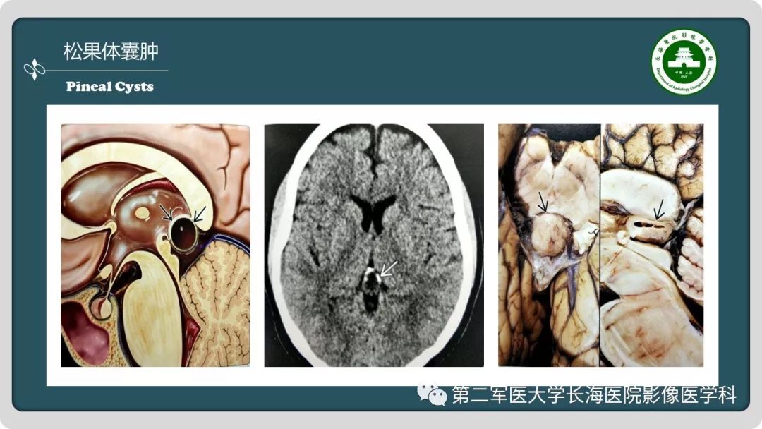 【PPT】颅内囊性病变影像表现-56