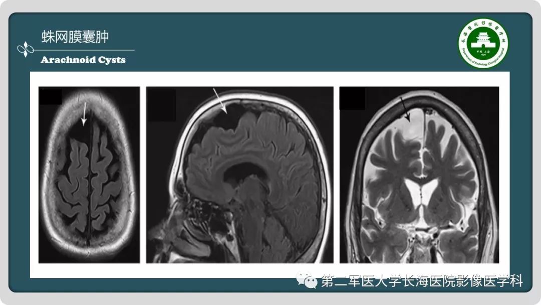 【PPT】颅内囊性病变影像表现-82