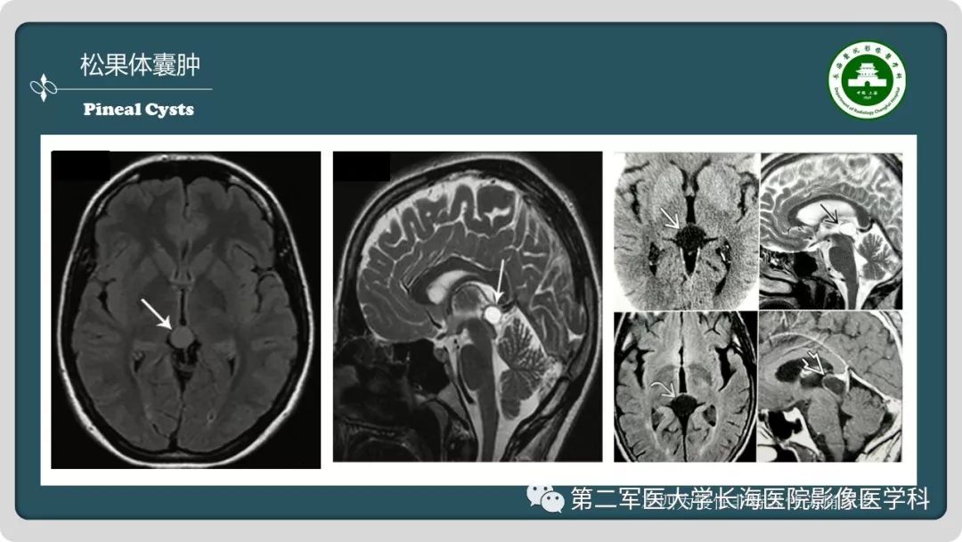 【PPT】颅内囊性病变影像表现-57