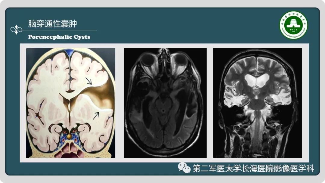 【PPT】颅内囊性病变影像表现-23