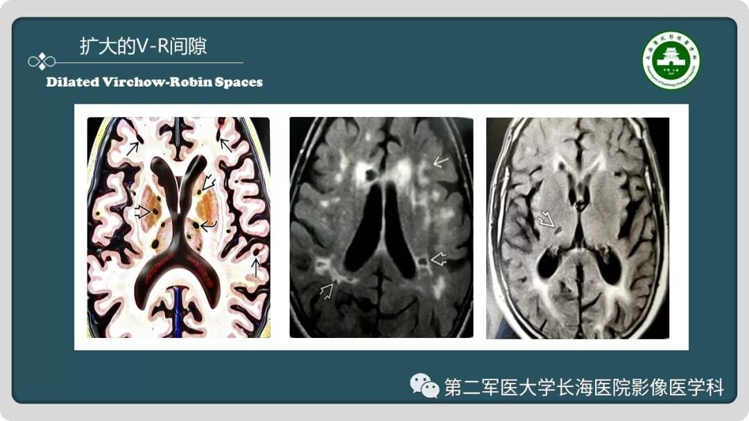 【PPT】颅内囊性病变影像表现-17