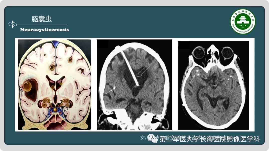 【PPT】颅内囊性病变影像表现-88