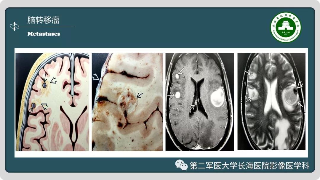 【PPT】颅内囊性病变影像表现-43