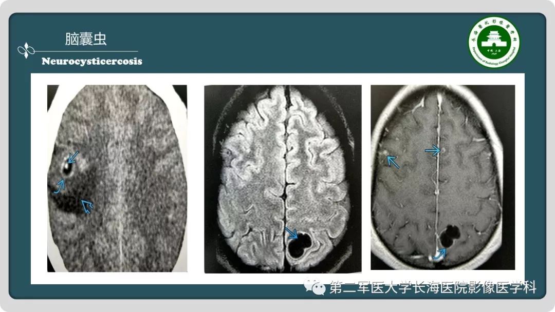 【PPT】颅内囊性病变影像表现-89