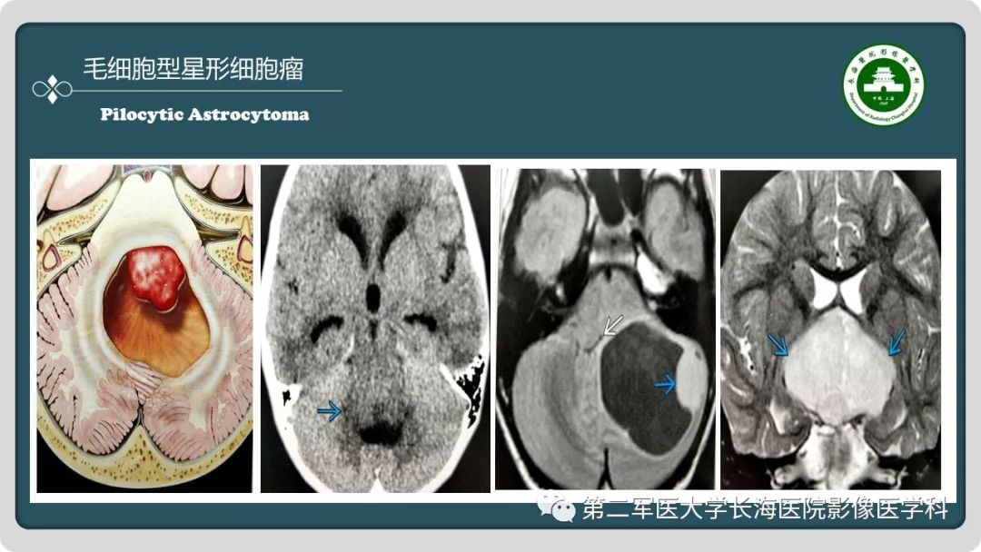 【PPT】颅内囊性病变影像表现-40