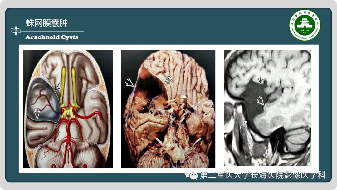 【PPT】颅内囊性病变影像表现-79