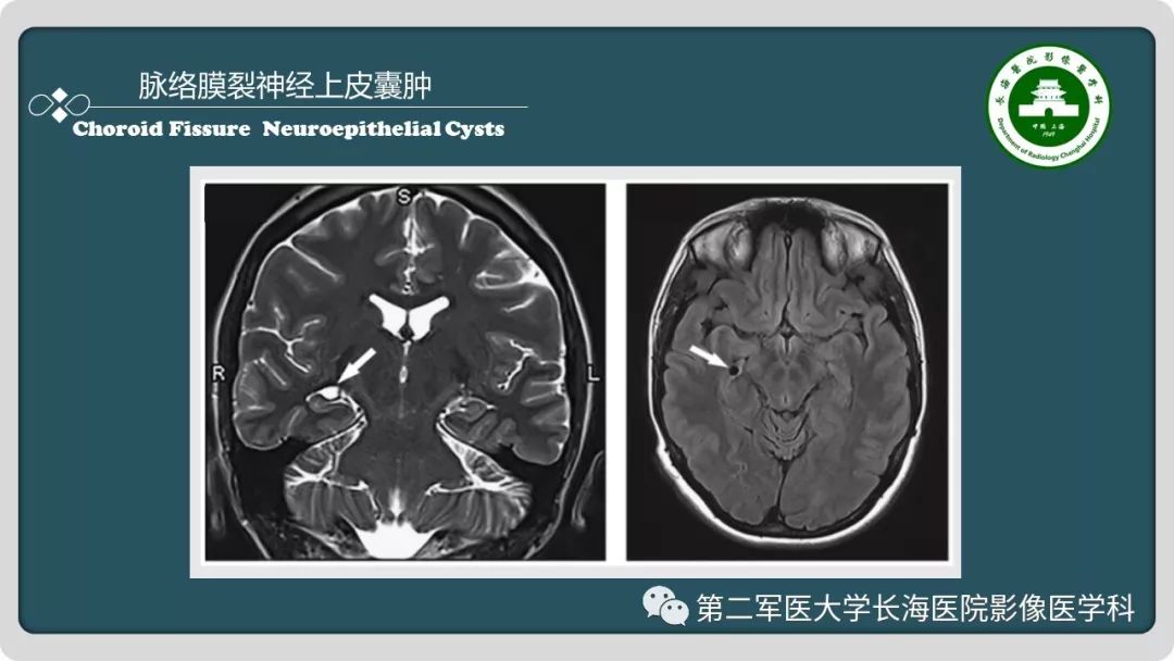 【PPT】颅内囊性病变影像表现-26