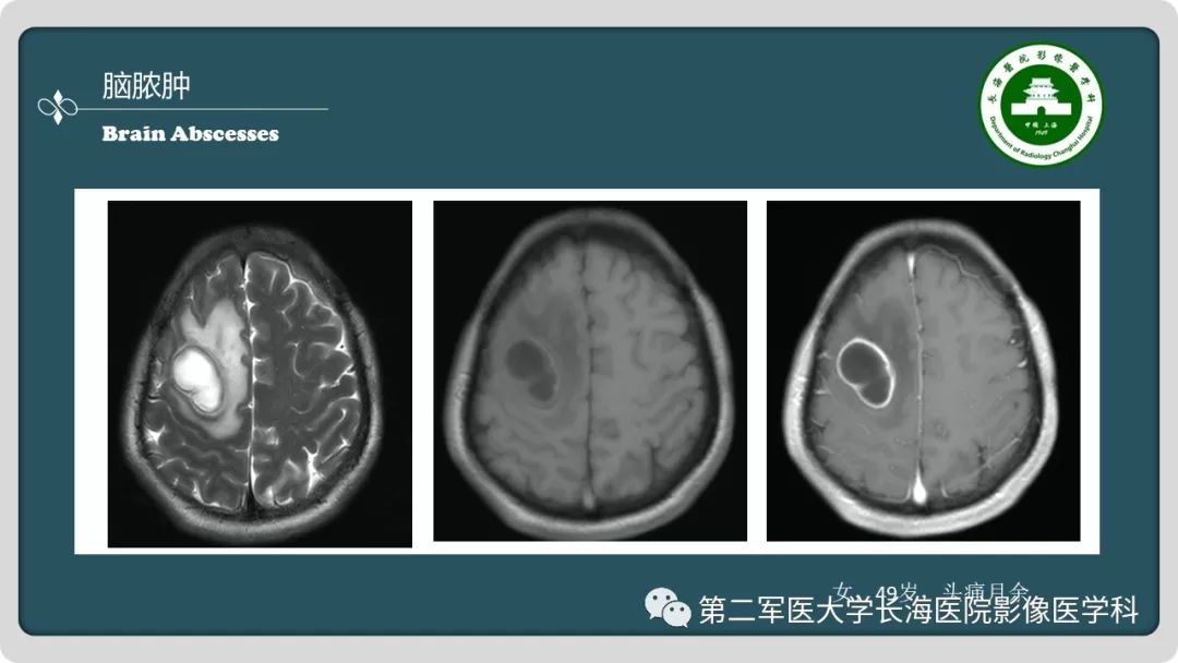 【PPT】颅内囊性病变影像表现-33