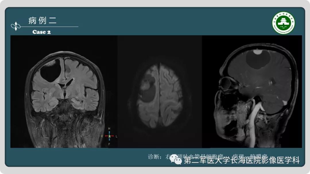 【PPT】颅内囊性病变影像表现-5