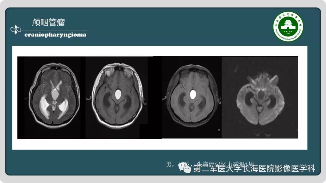 【PPT】颅内囊性病变影像表现-76