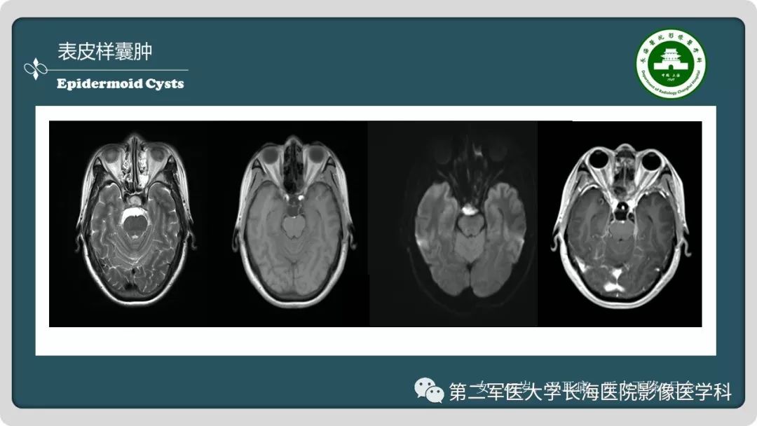 【PPT】颅内囊性病变影像表现-86