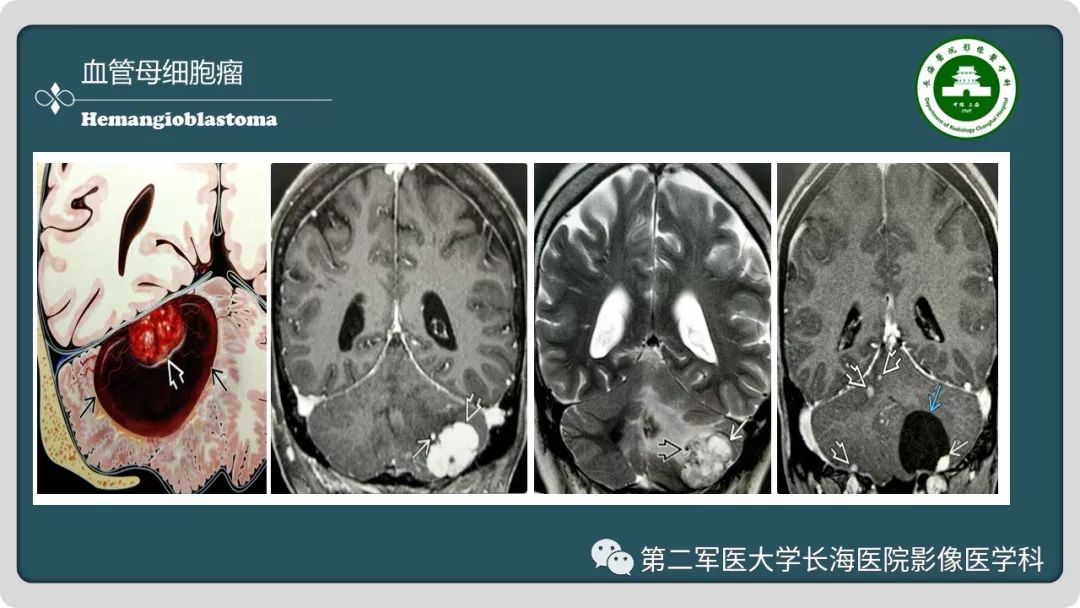 【PPT】颅内囊性病变影像表现-36