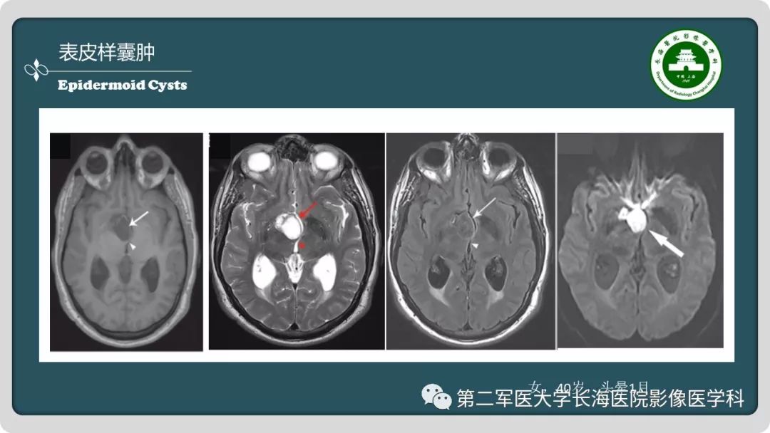 【PPT】颅内囊性病变影像表现-85