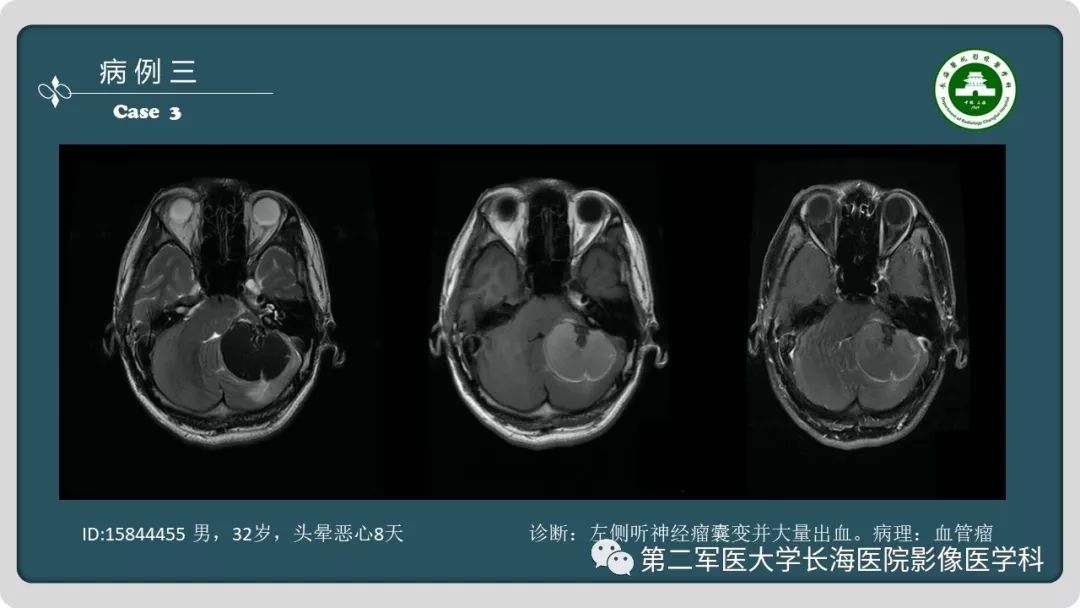 【PPT】颅内囊性病变影像表现-7