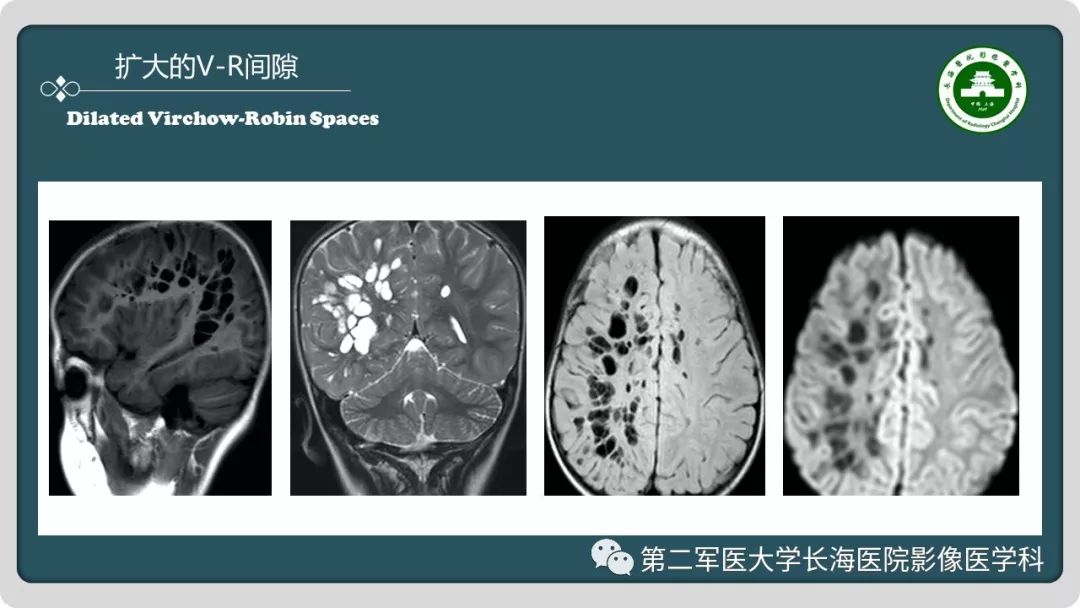 【PPT】颅内囊性病变影像表现-18