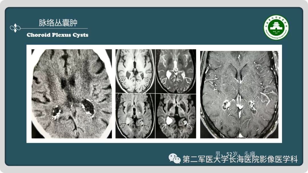 【PPT】颅内囊性病变影像表现-49