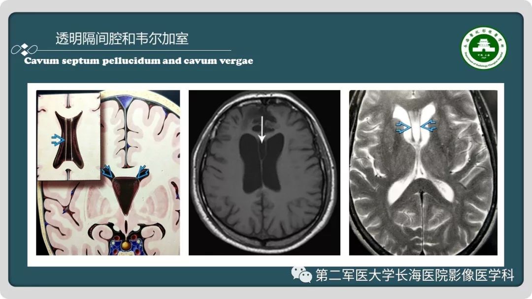 【PPT】颅内囊性病变影像表现-59