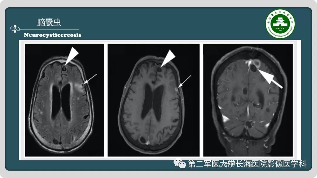 【PPT】颅内囊性病变影像表现-90