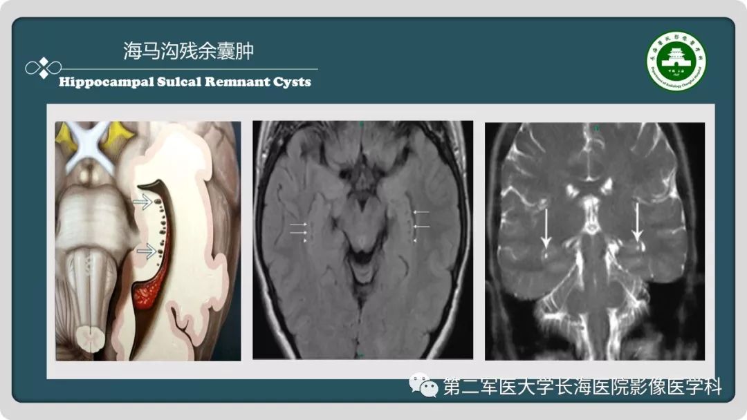 【PPT】颅内囊性病变影像表现-20