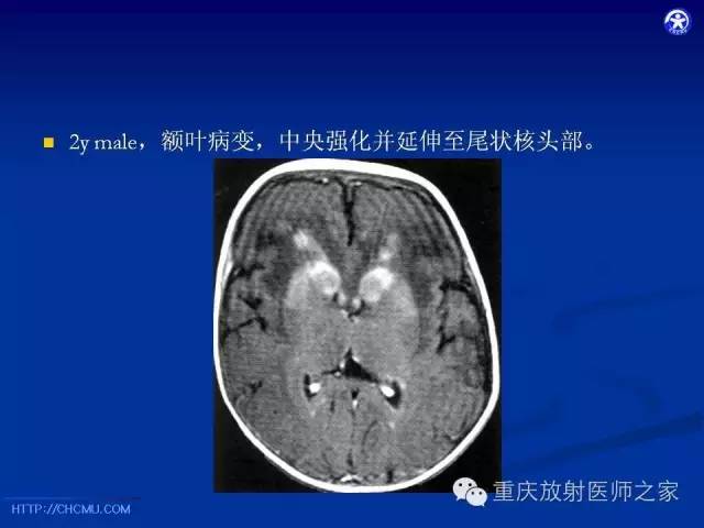 【PPT】脑白质髓鞘化及相关疾病的MRI表现-22