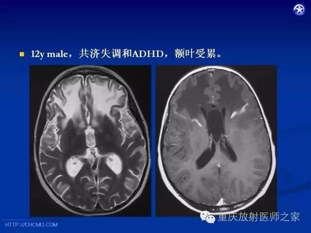 【PPT】脑白质髓鞘化及相关疾病的MRI表现-34