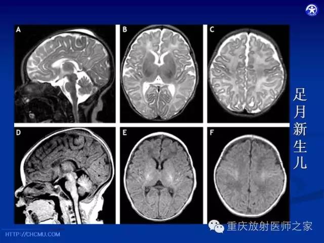 【PPT】脑白质髓鞘化及相关疾病的MRI表现-9
