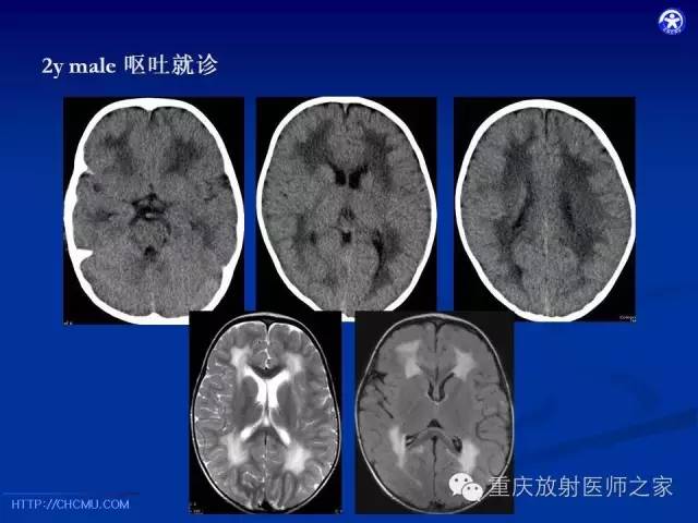 【PPT】脑白质髓鞘化及相关疾病的MRI表现-36