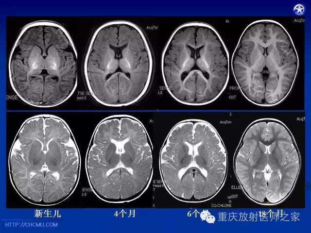 【PPT】脑白质髓鞘化及相关疾病的MRI表现-10