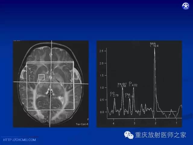【PPT】脑白质髓鞘化及相关疾病的MRI表现-26