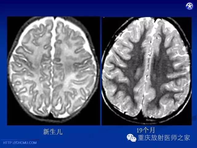 【PPT】脑白质髓鞘化及相关疾病的MRI表现-2
