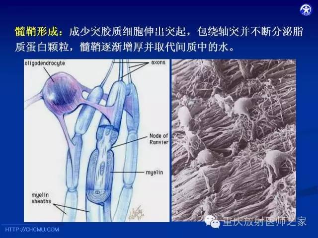 【PPT】脑白质髓鞘化及相关疾病的MRI表现-4