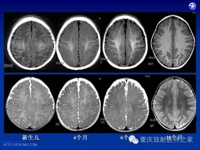 【PPT】脑白质髓鞘化及相关疾病的MRI表现-11