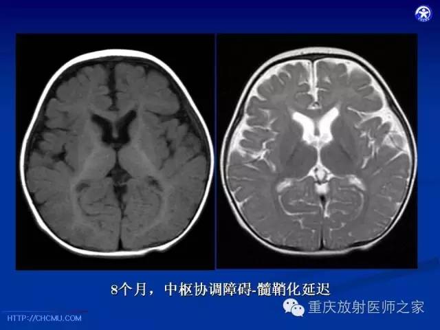 【PPT】脑白质髓鞘化及相关疾病的MRI表现-15
