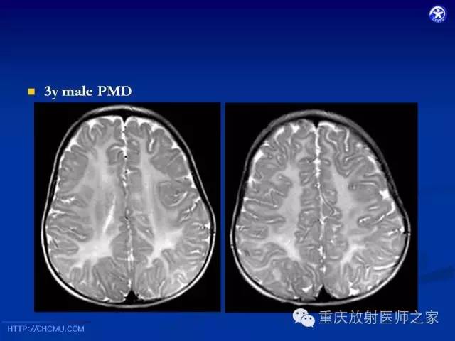 【PPT】脑白质髓鞘化及相关疾病的MRI表现-39