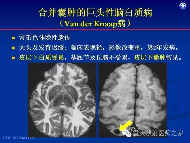 【PPT】脑白质髓鞘化及相关疾病的MRI表现-27