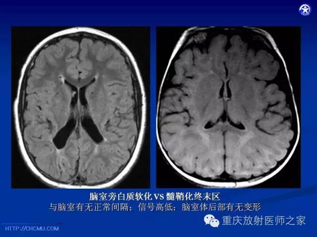 【PPT】脑白质髓鞘化及相关疾病的MRI表现-14