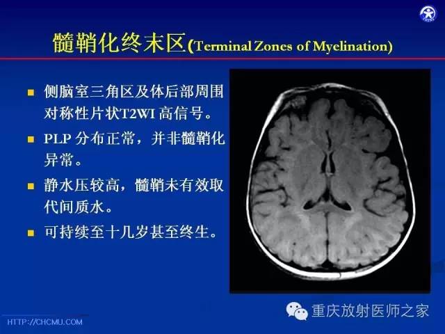 【PPT】脑白质髓鞘化及相关疾病的MRI表现-13