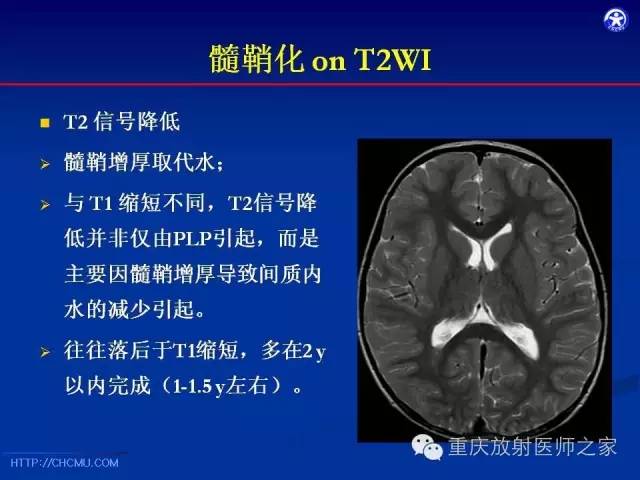 【PPT】脑白质髓鞘化及相关疾病的MRI表现-7