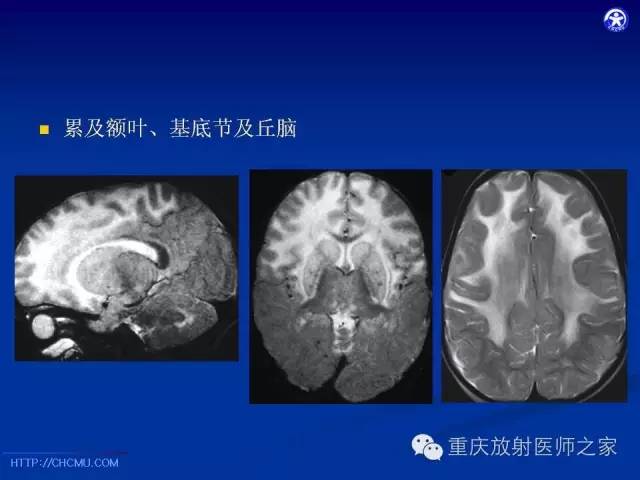 【PPT】脑白质髓鞘化及相关疾病的MRI表现-23
