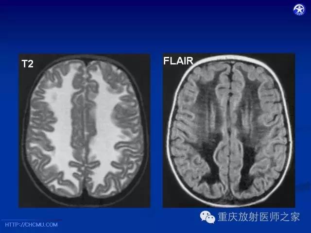 【PPT】脑白质髓鞘化及相关疾病的MRI表现-29