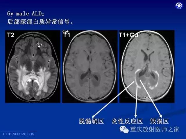 【PPT】脑白质髓鞘化及相关疾病的MRI表现-33